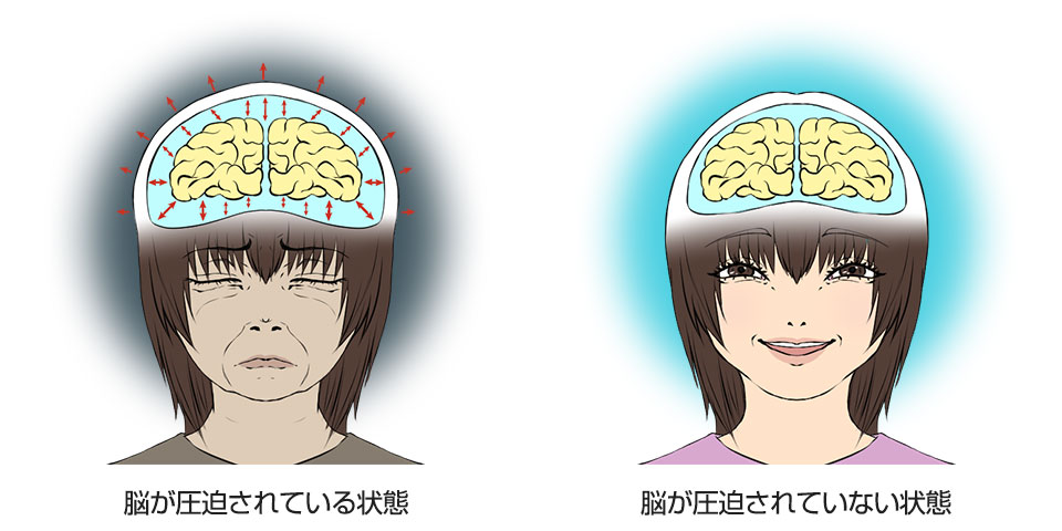 脳圧亢進