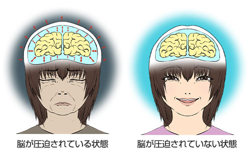 脳圧亢進